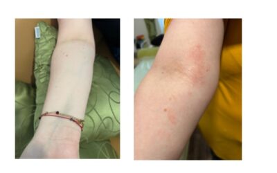 Atopický ekzém – příběh z pohledu TCM a výživy